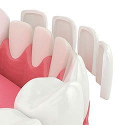 veneers illustration