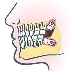 a cartoon version of dental x-ray showing two impacted teeth